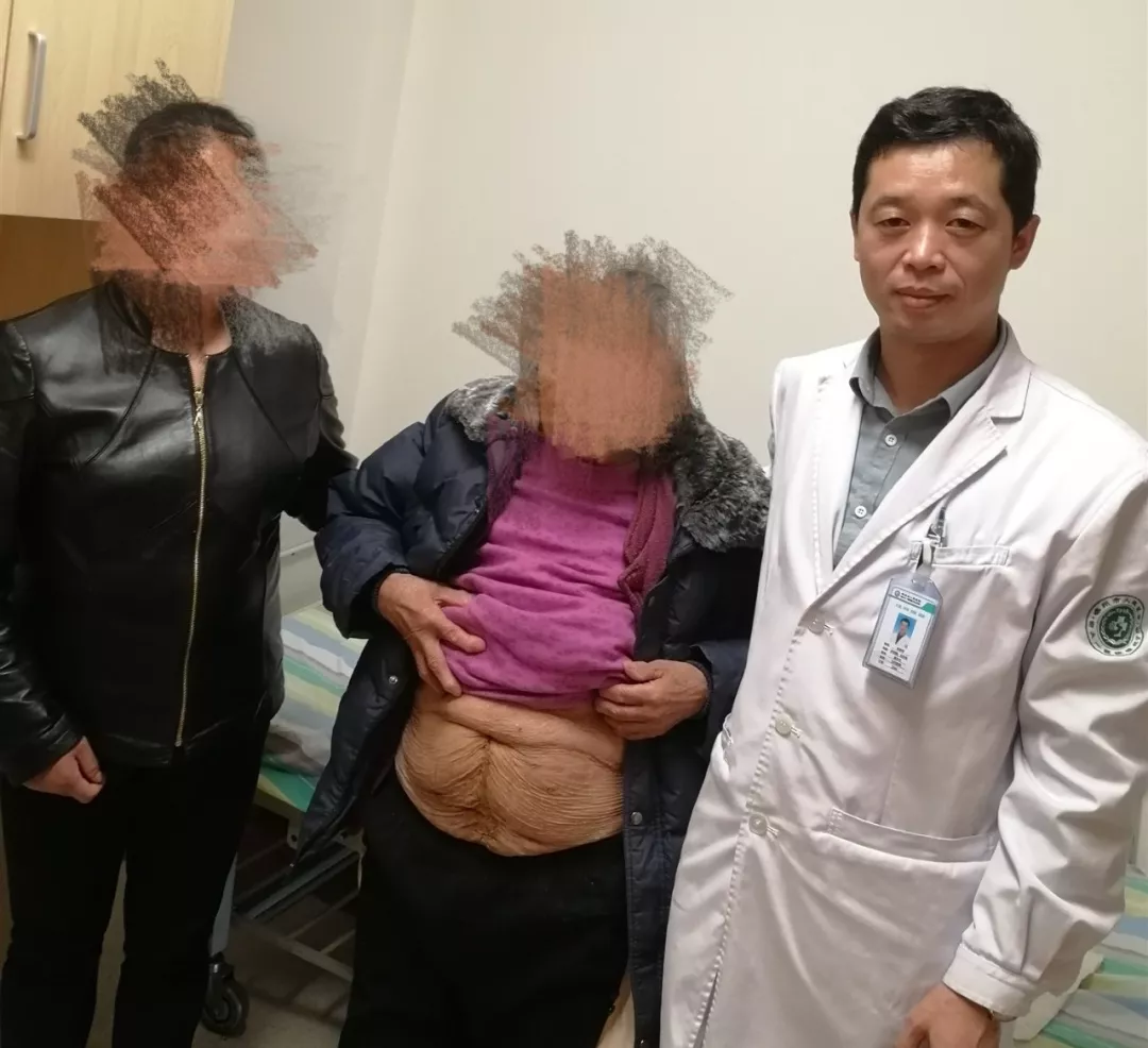 8旬老人“带球跑” 医生妙手解痛苦 ——我院疝腹壁外科完成高难度的巨大切口疝手术