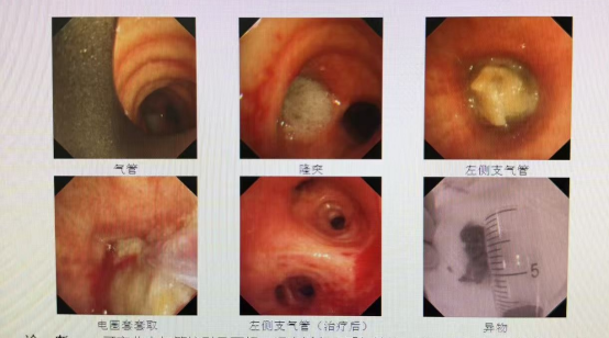 八旬老人呼吸衰竭，医生镜下“钓”出元凶……竟是浙江人春天饭桌上的常客！