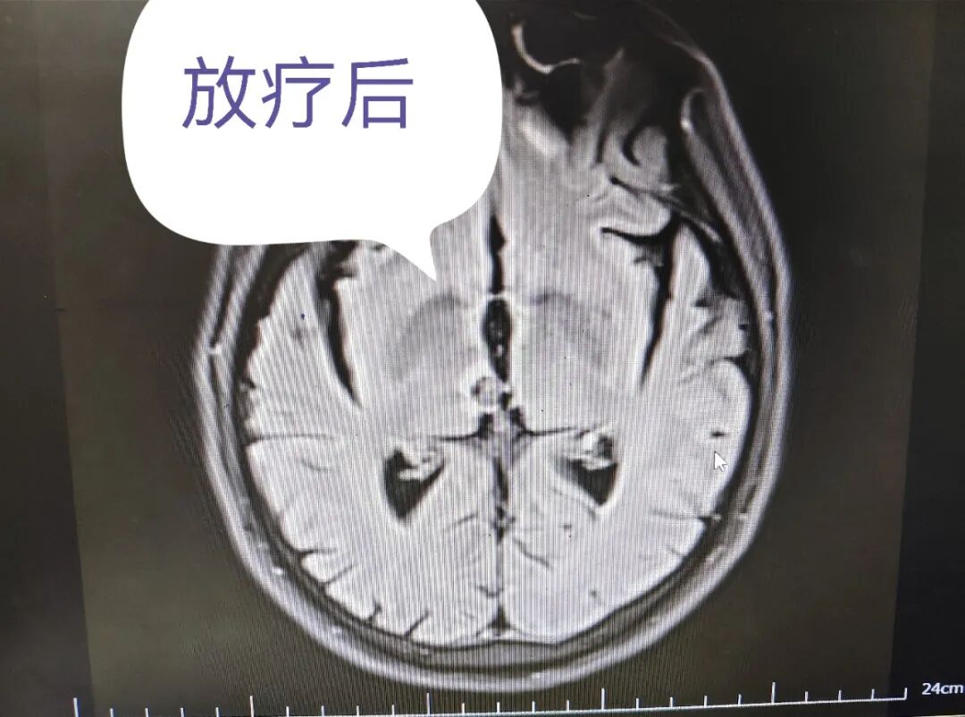 精准放疗破局晚期困境，为生命重启希望之光