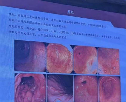 俞医生和你说——胃镜查出“糜烂”=胃烂了吗？