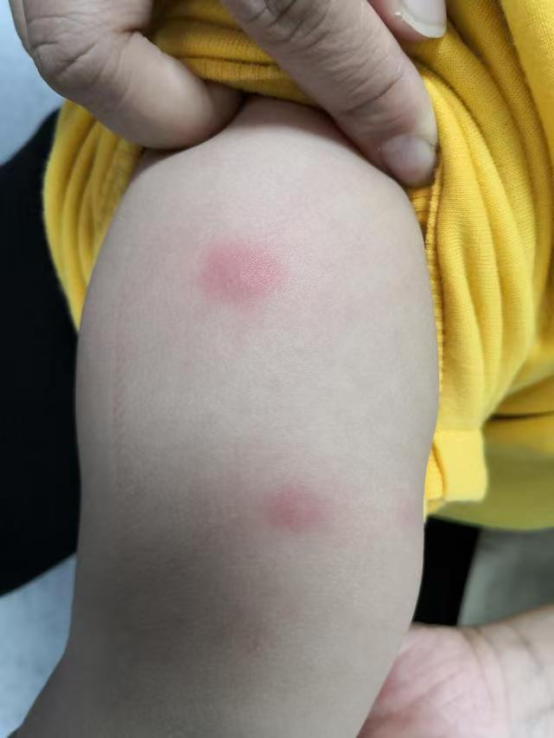 宝宝身上起了“红疙瘩”总不好？医生提醒：夏天带娃，这个细节千万别忽视！